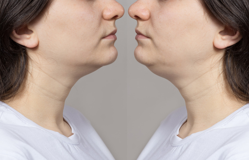 Fat Reduction
