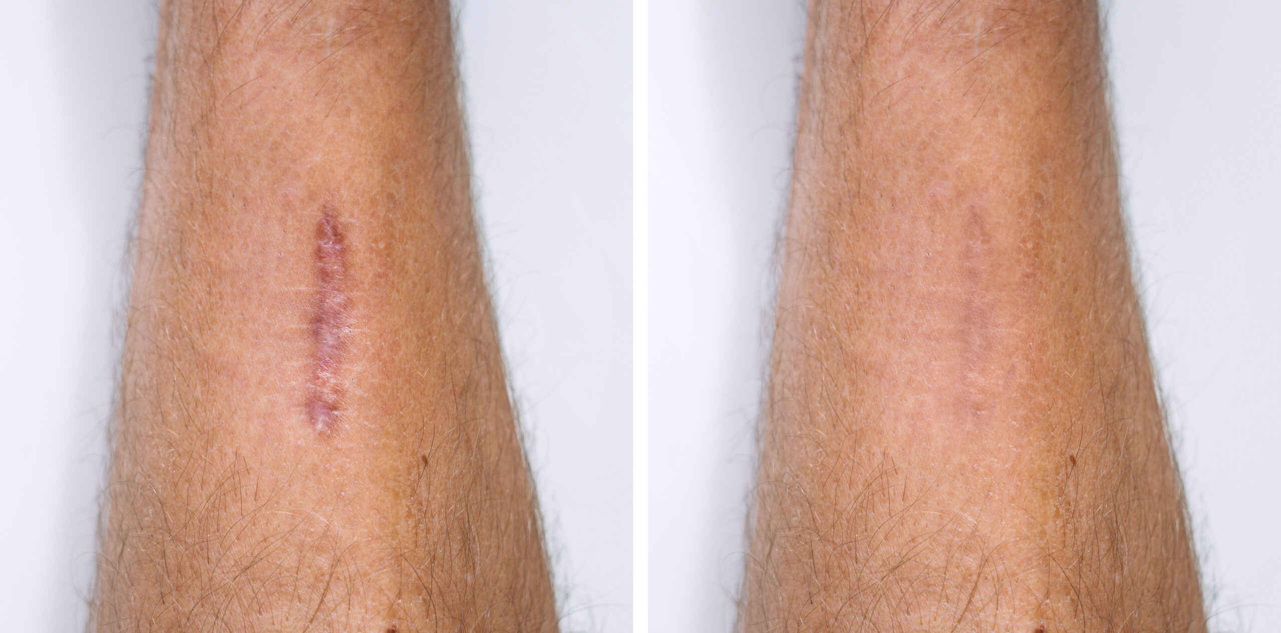 Scar Revision