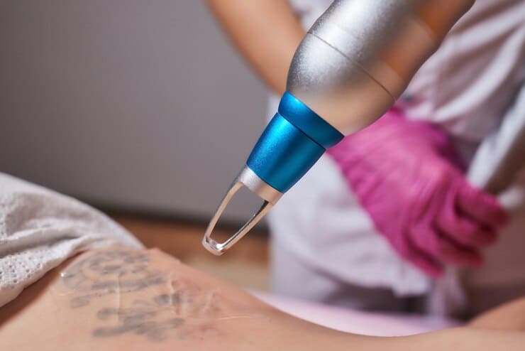 Tattoo Removal