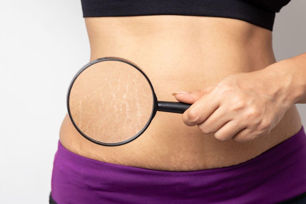 Affected by Stretch Marks