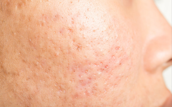 Alternative Scar treatment