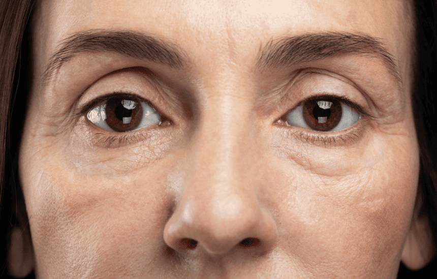 Candidates for a Laser Facelift Candidates for a Laser Facelift