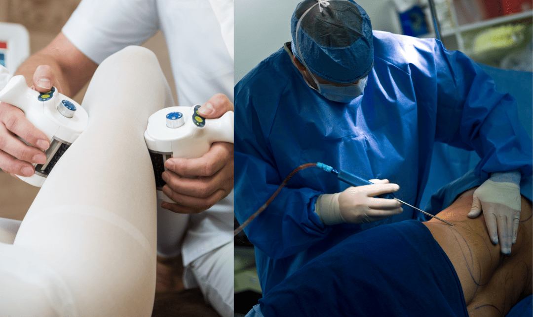 Comparing Laser Fat Reduction