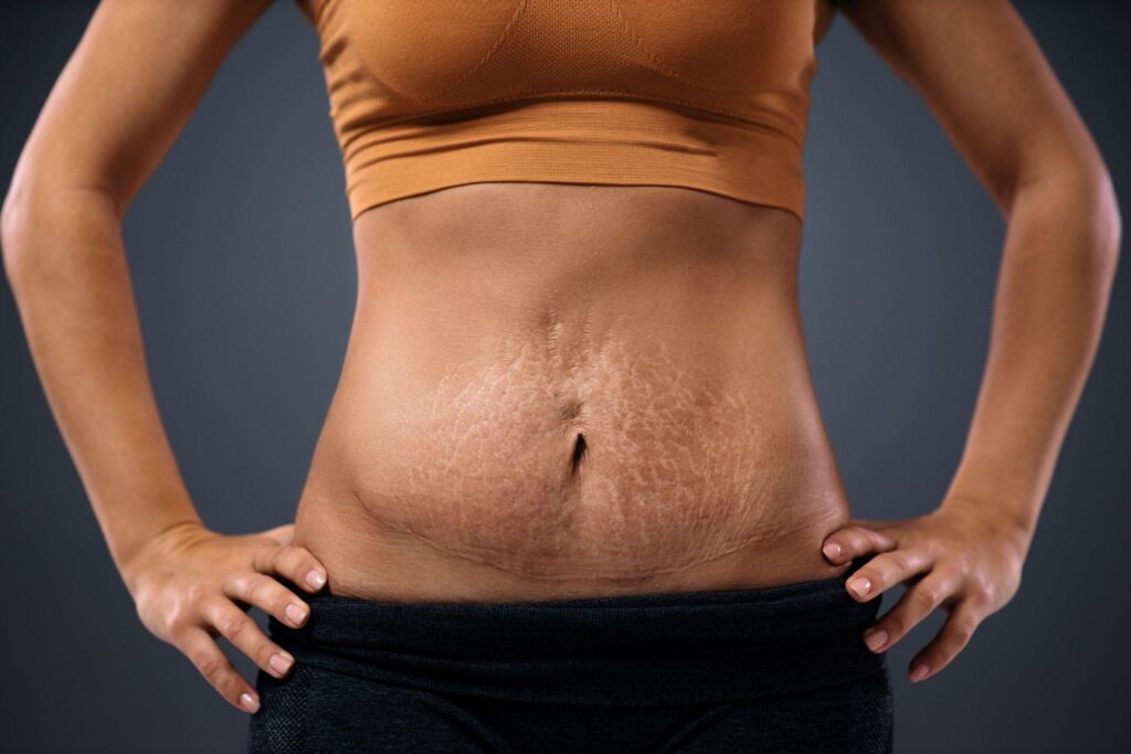 Cost of Laser Treatment for Stretch Marks