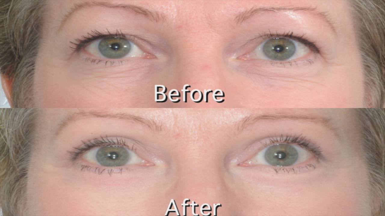 Laser Blepharoplasty Recovery