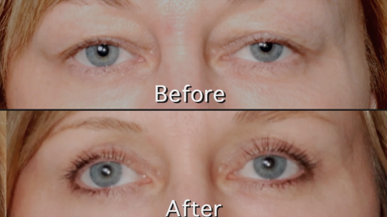 Laser Blepharoplasty