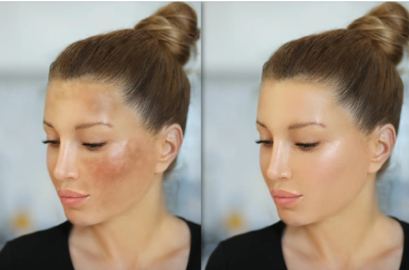 Laser Pigmentation Removal Works