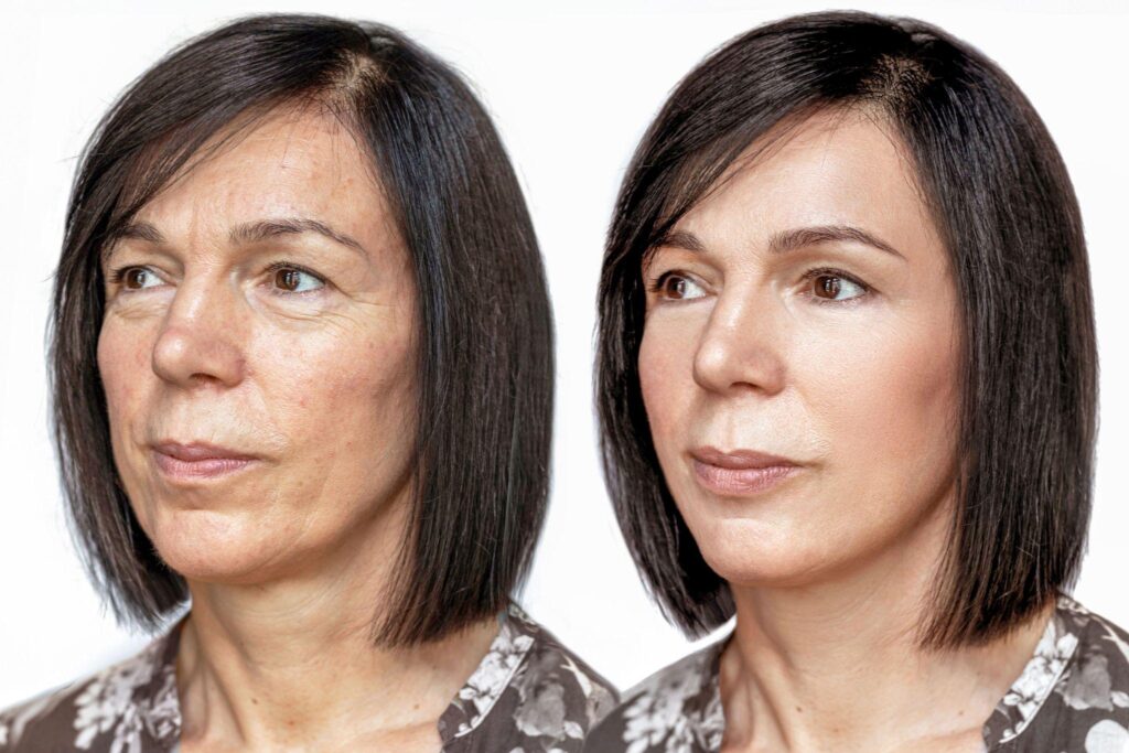 Laser Skin Tightening