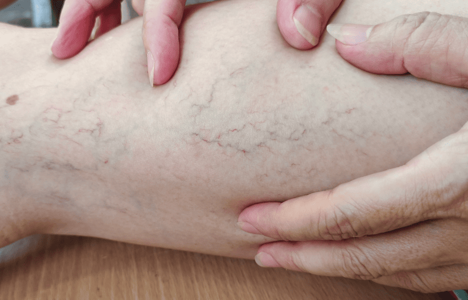  Laser Vein Removal
