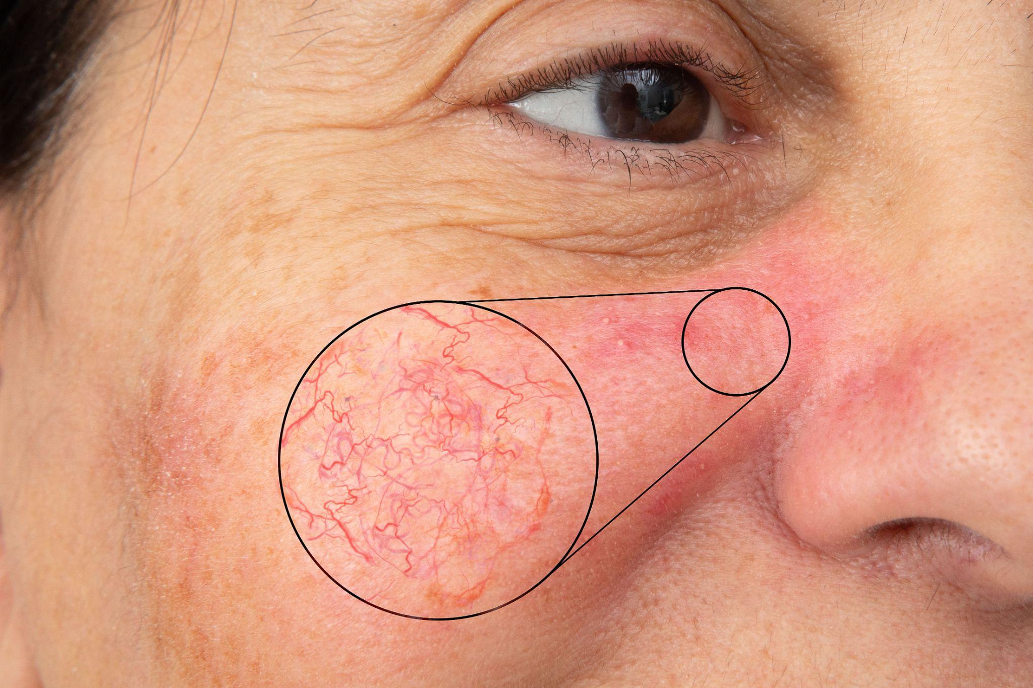 Procedure for Laser Solutions for Rosacea