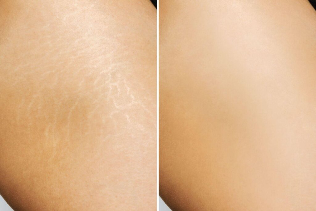 Skin Resurfacing For Stretch Marks