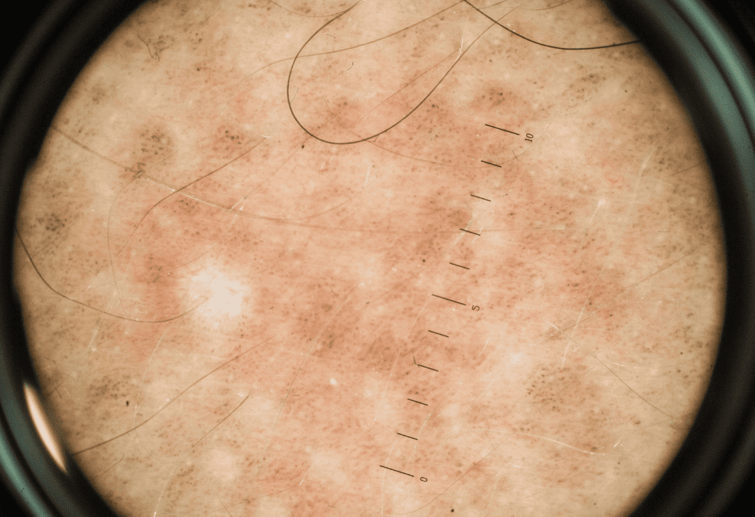 Sun Exposure Causes Photoaging