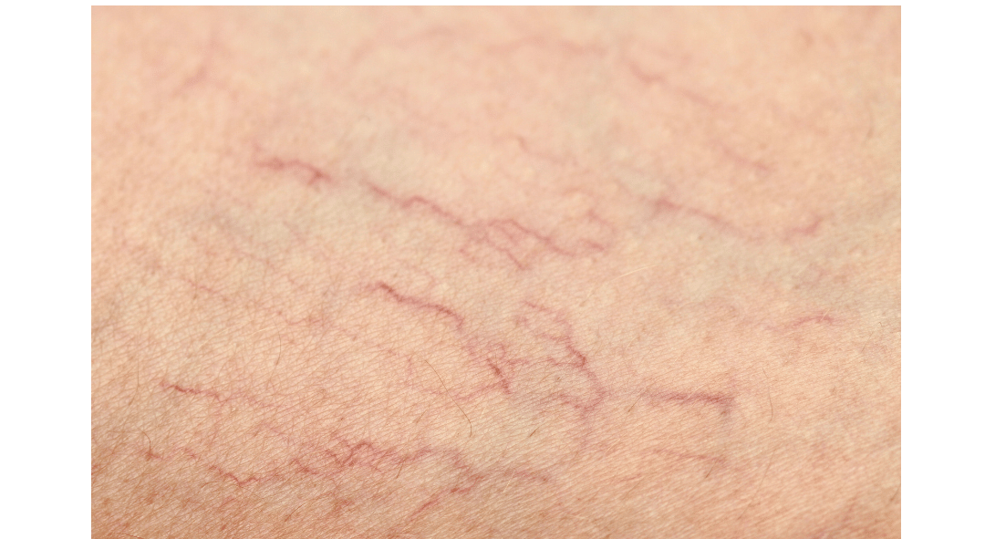 Thread-Veins