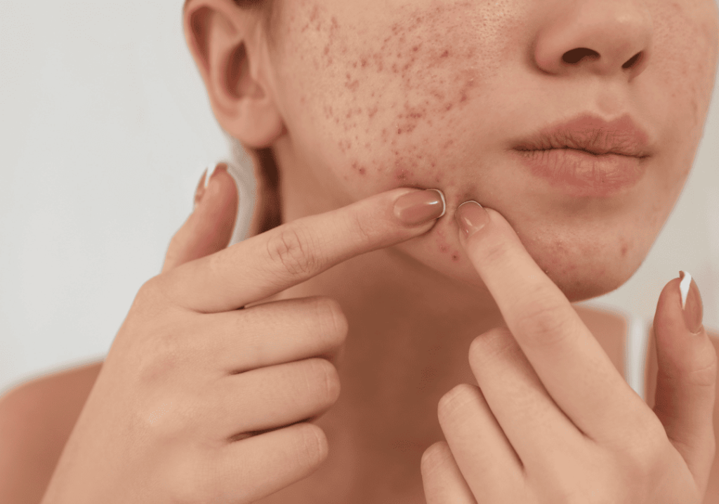 Treatment for Acne Scars