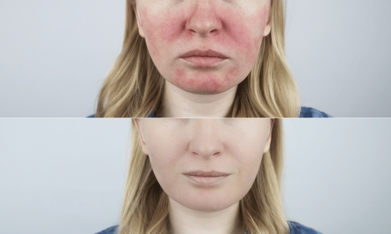 What are the Effective Laser Treatments for Rosacea Symptoms