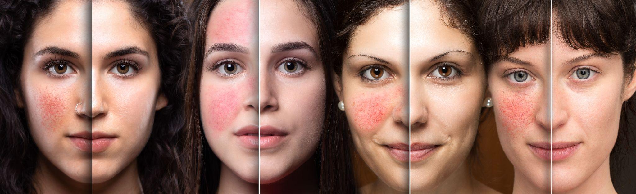 What is the Cost of Laser Treatment for Rosacea
