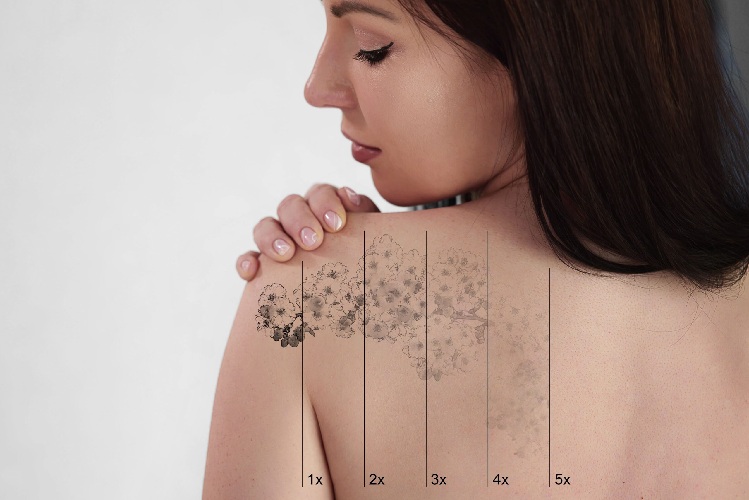 tattoo removal
