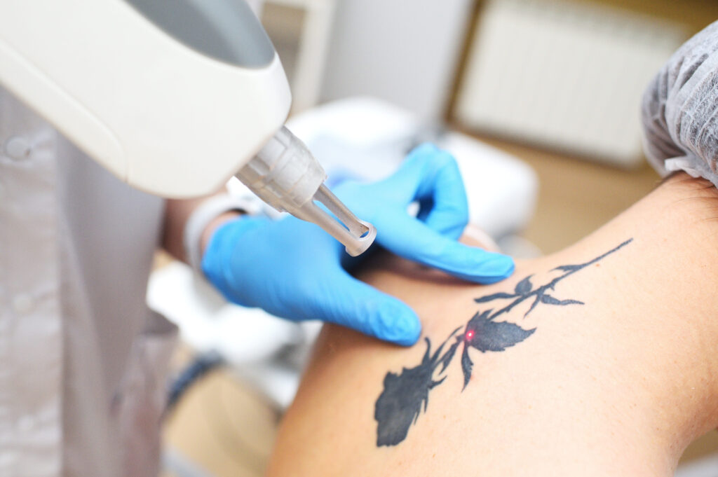 Laser Tattoo